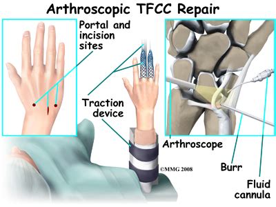 triangular fibrocartilage complex tear repair